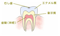 C0 ごく初期の虫歯