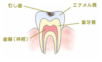 C1 表面の虫歯