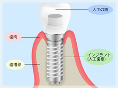 インプラントで第二の永久歯を手に入れる