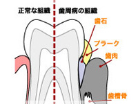 実は恐ろしい歯周病