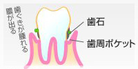 歯周炎（軽度）