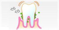 歯周炎（重度）